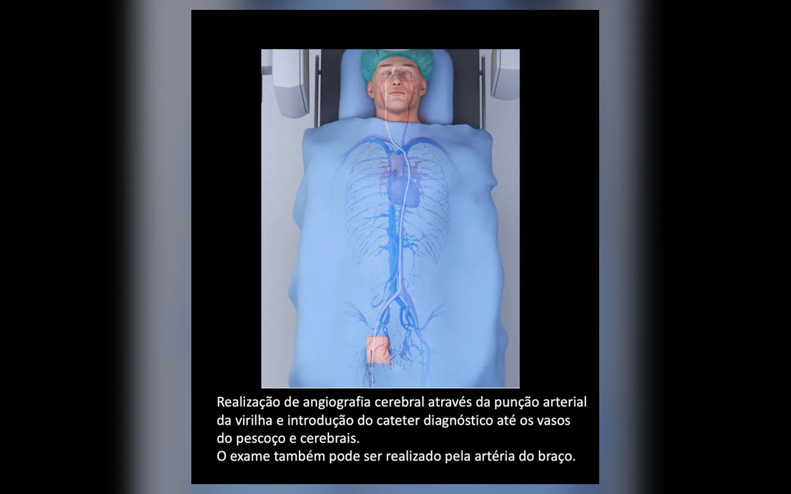 Neurorradiologia Intervencionista