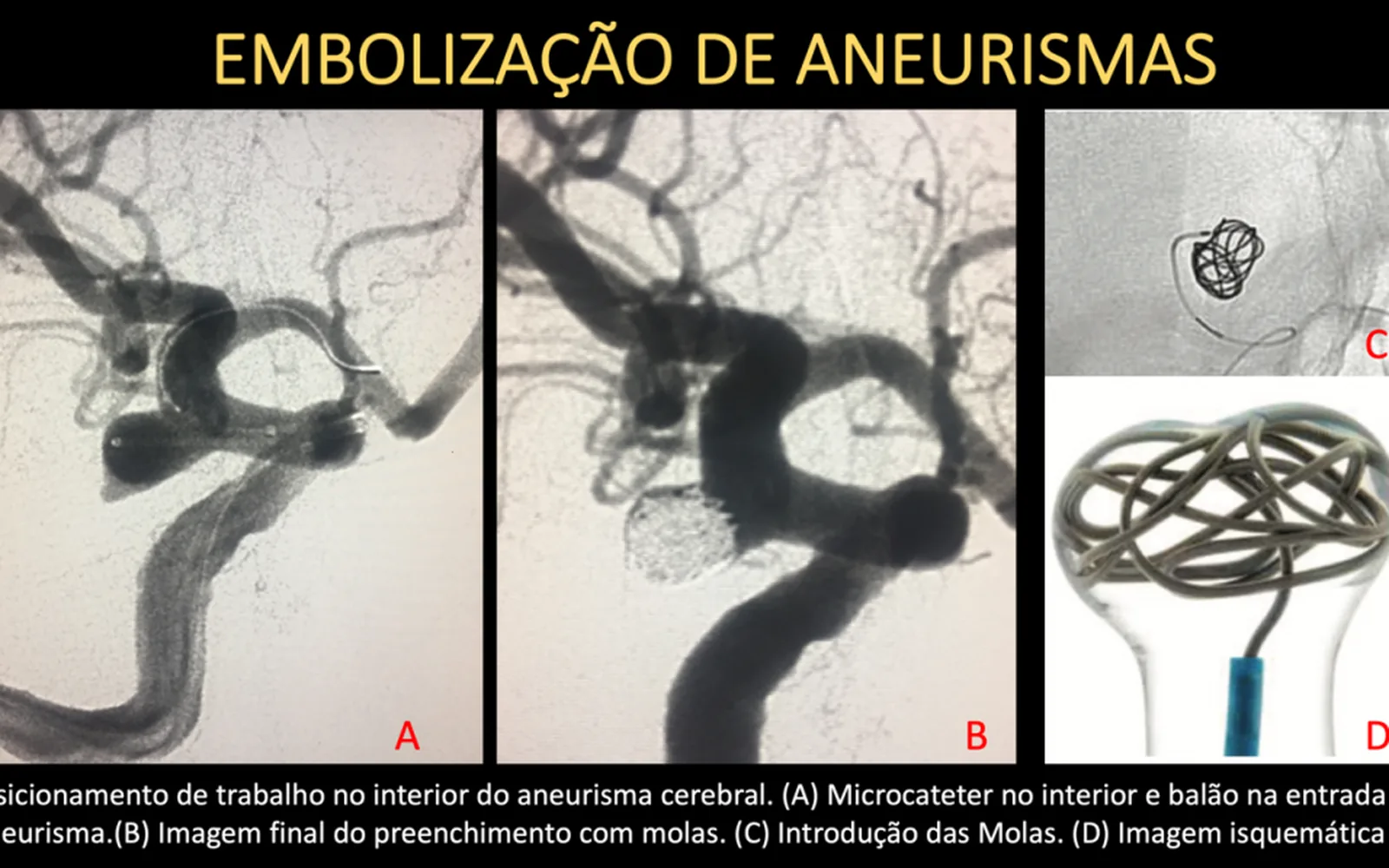 O que é Neurorradiologia Intervencionista?