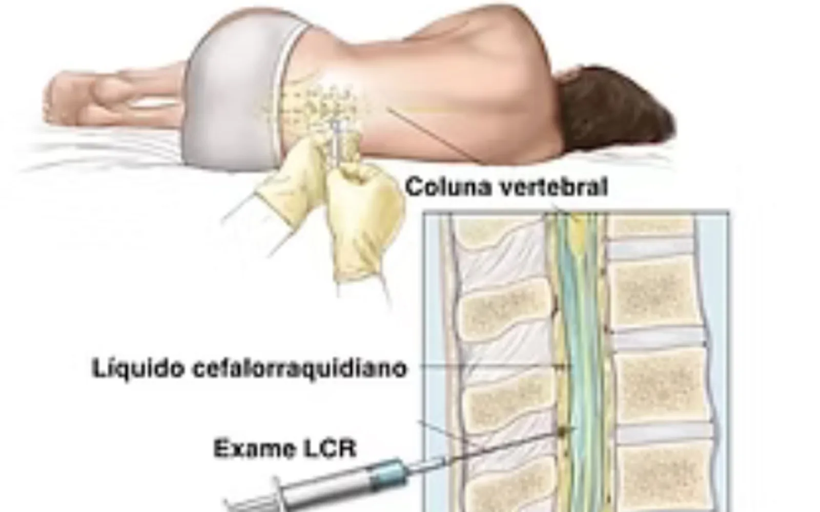 Entenda o TAP Test: O Exame que Ajuda a Diagnosticar a Hidrocefalia de Pressão Normal
